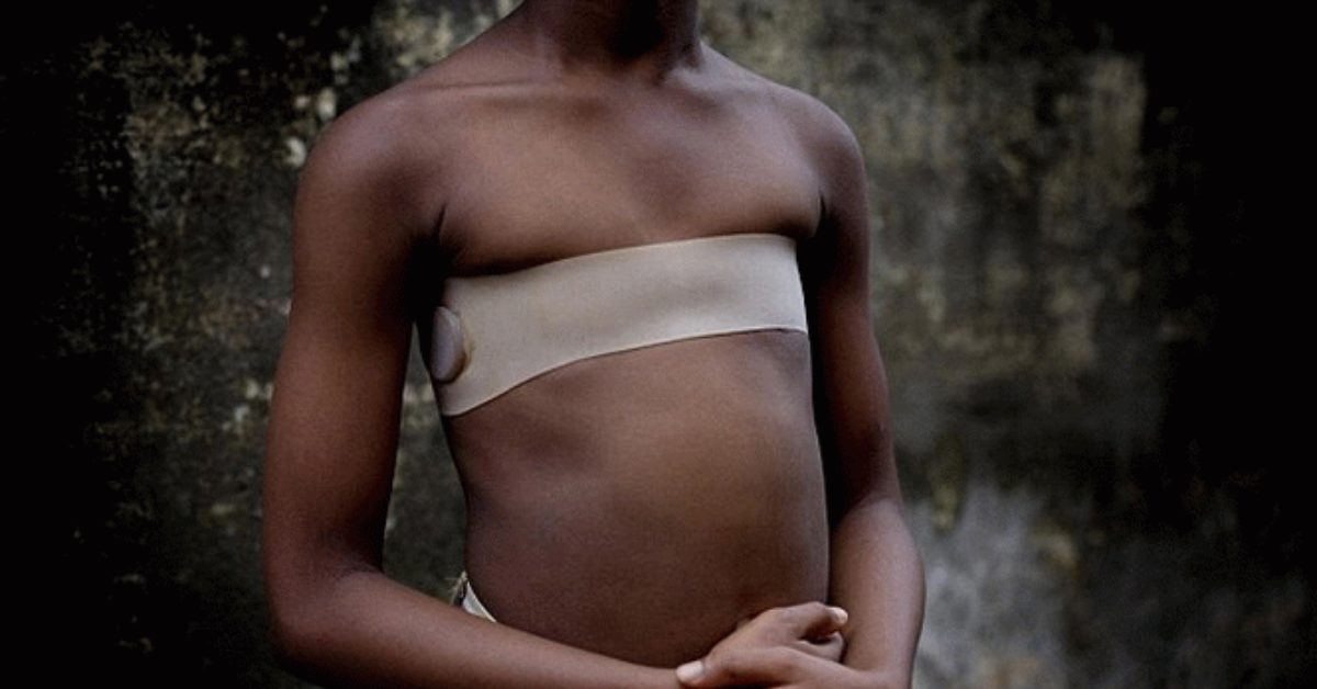 Repassage des seins : halte à la torture ! – HelloPlanet.tv